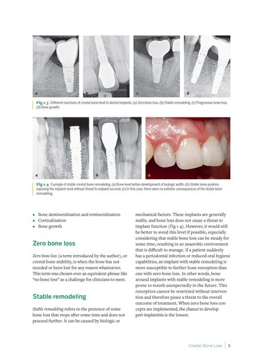 Zero Bone Loss Concepts 1st Edition 2019