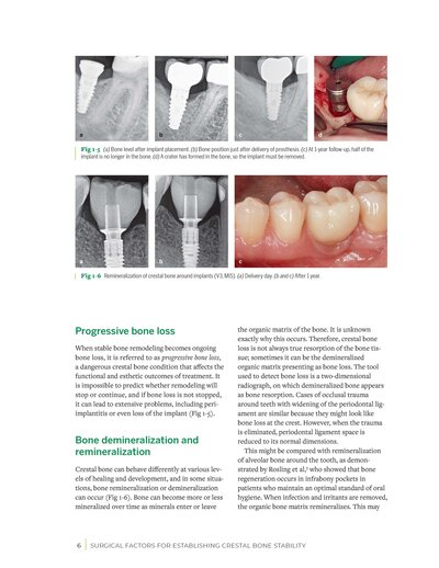 Zero Bone Loss Concepts 1st Edition 2019