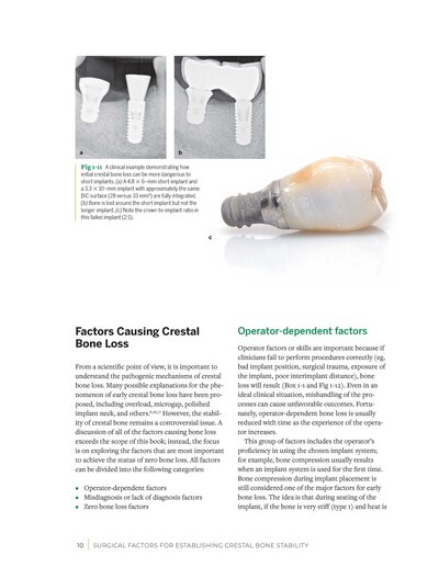 Zero Bone Loss Concepts 1st Edition 2019